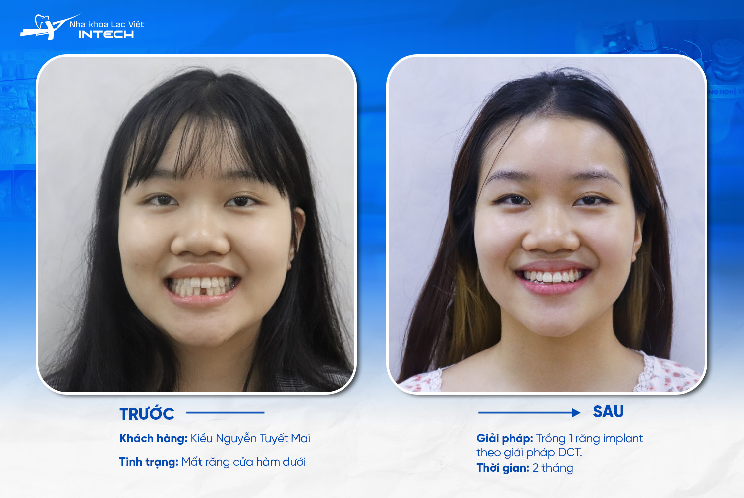 Hình ảnh trồng răng Implant từng giai đoạn tại Lạc Việt Intech