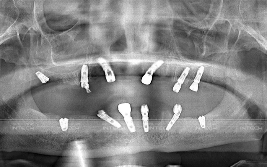 Chú Khích được bác sĩ Nguyễn Hoàng Dương chỉ định điều trị bằng phương pháp All-On-6