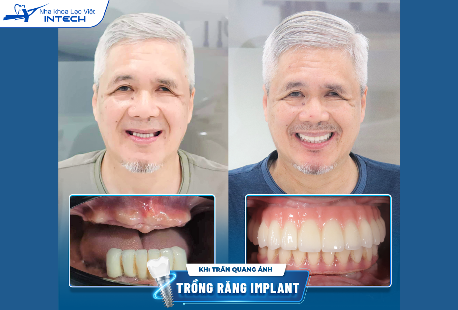 Chú Ánh đã điều trị thành công toàn hai hàm bằng phương pháp All-On-6