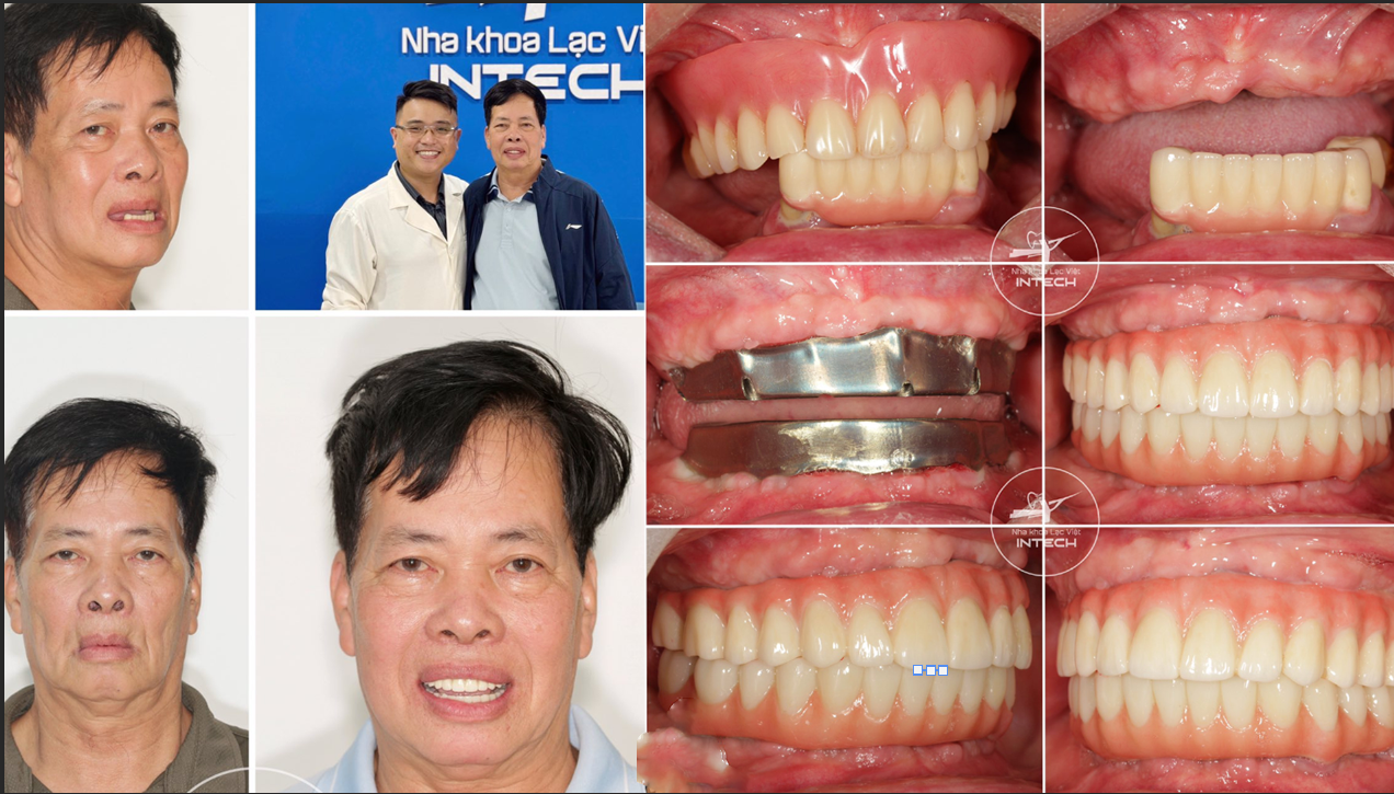Một khách hàng khác được bác sĩ Nguyễn Hoàng Dương điều trị theo phương pháp phục hình Implant cả hai hàm
