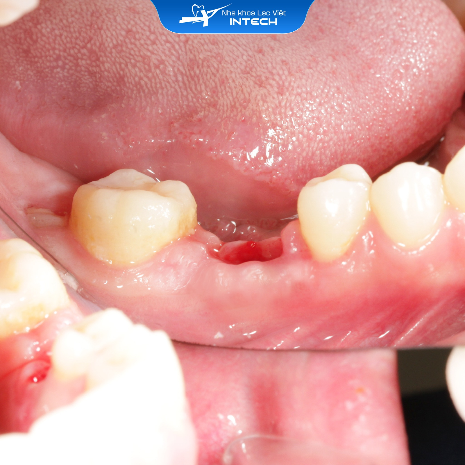 Bác sĩ sẽ dùng các dụng cụ hiện đại để tách mô mềm và xương, tạo lỗ chờ cắm Implant ít xâm lấn nhất có thể
