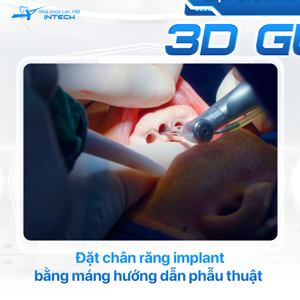 Máng hướng dẫn phẫu thuật Guideline được thiết kế cá nhân hóa giúp bác sĩ đặt trụ chính xác hơn