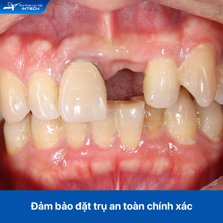 Anh Vũ Ngọc Đức đã đến điều trị tại nha khoa Lạc Việt Intech với tình trạng bị mất 1 răng cửa hàm trên