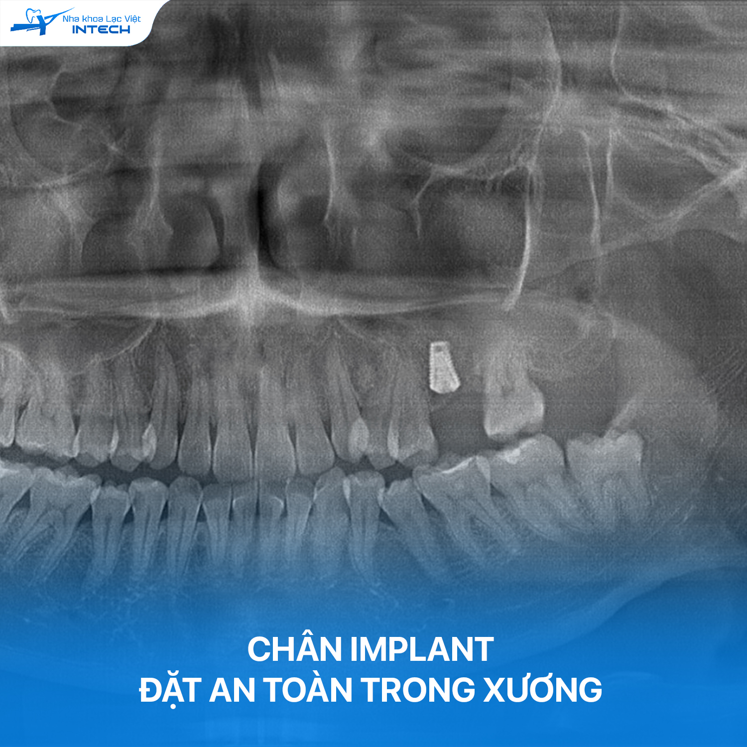 Trụ Implant được đặt an toàn với vị trí, phương và hướng chính xác trong xương hàm