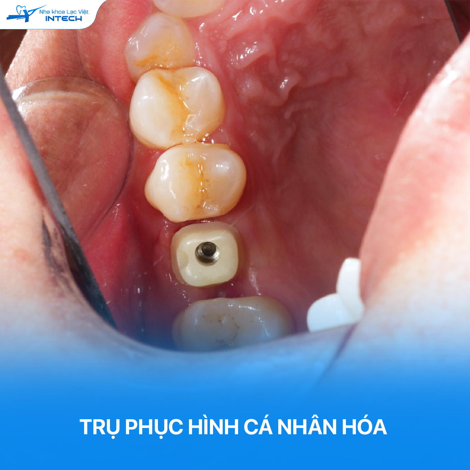 Trụ phục hình được thiết kế cá nhân hóa theo cấu trúc giải phẫu của mỗi người, được lắp trên trụ Implant khi đã hoàn toàn tích hợp xương