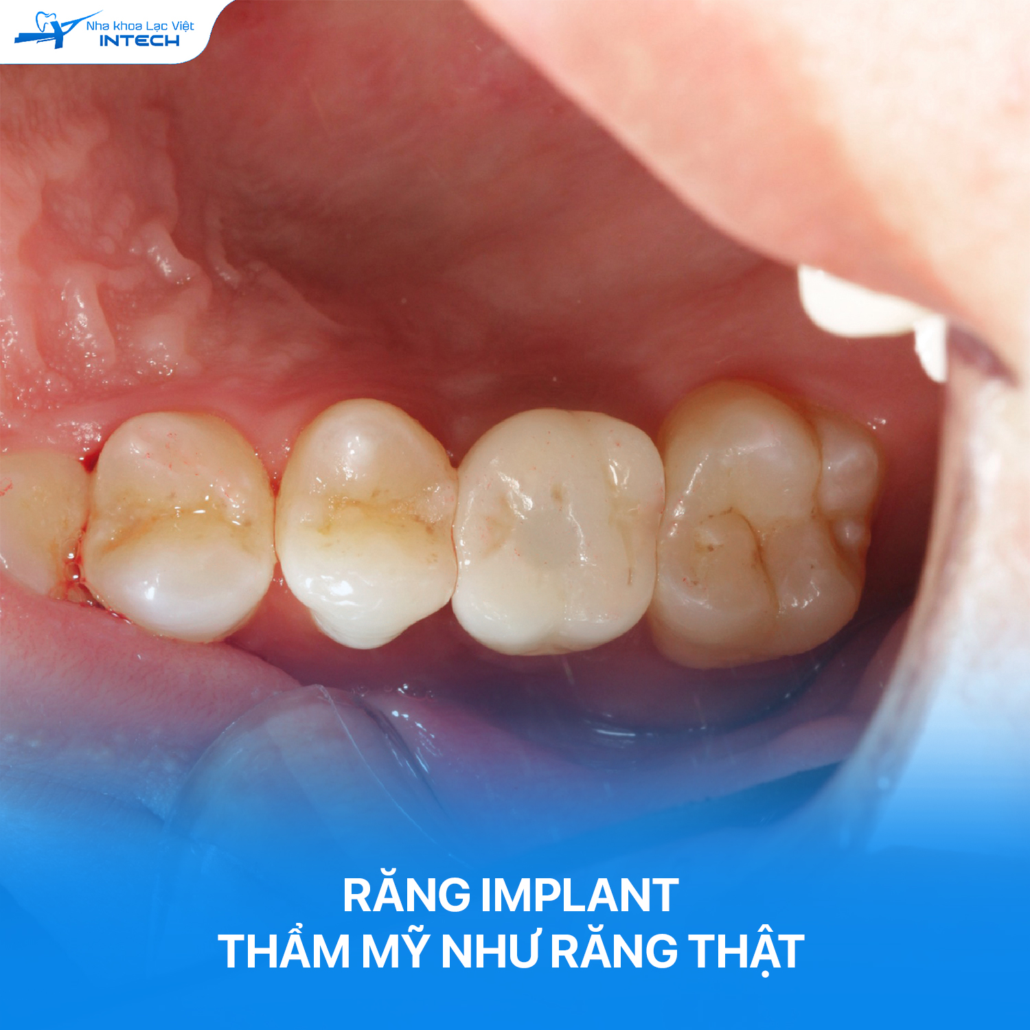Mão răng sứ cá nhân hóa có độ trong mờ và độ cứng như răng thật, được lắp bên trên trụ phục hình