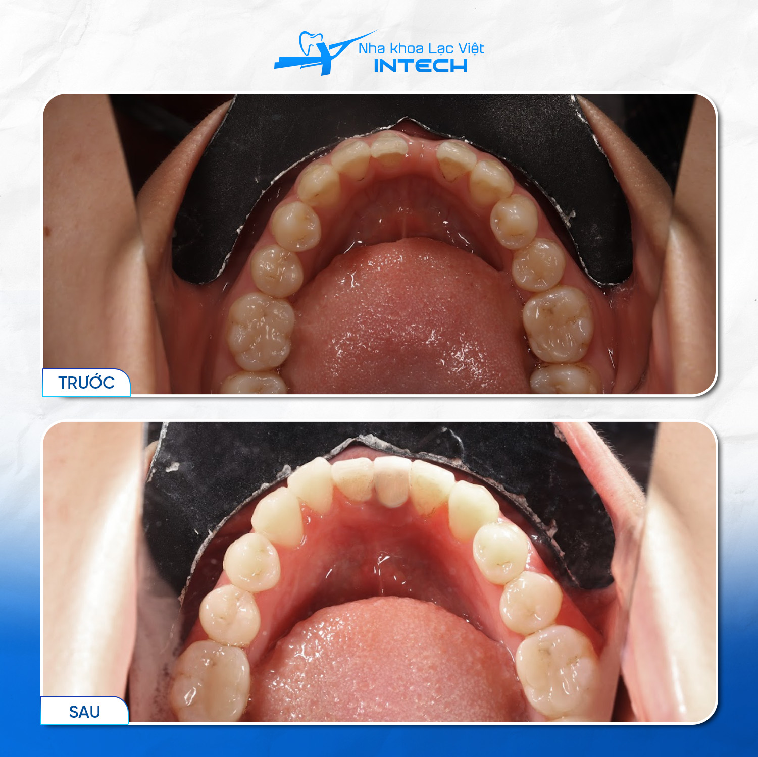 Răng Implant mới không những đảm bảo khả năng ăn nhai mà còn có thẩm mỹ như răng thật, không quá khác biệt với các răng tự nhiên xung quanh