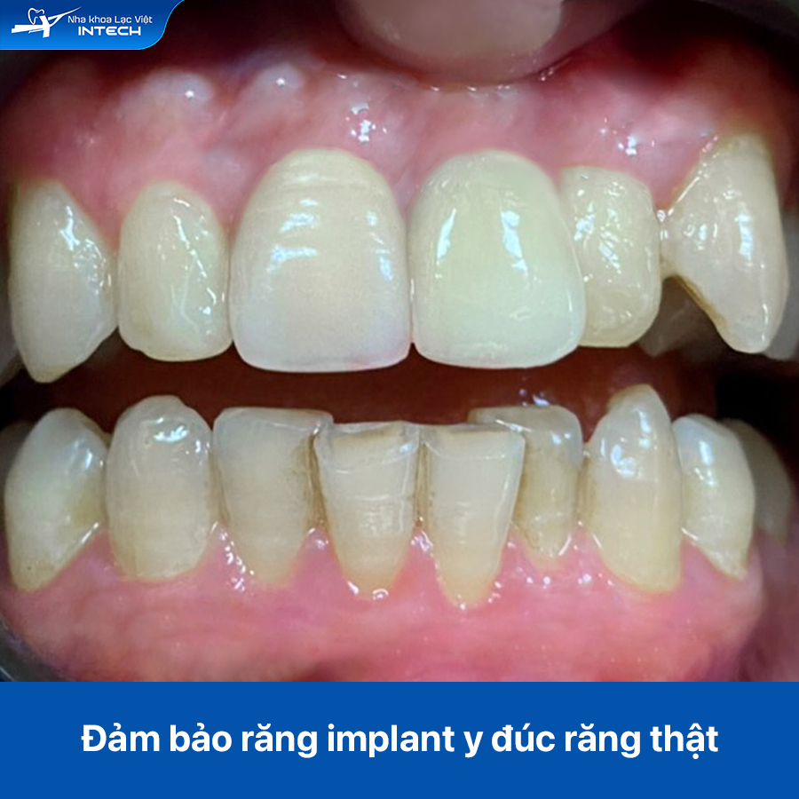 Sau khi điều trị bằng giải pháp cá nhân hóa DCT, răng Implant mới khôi phục khả năng ăn nhai và thẩm mỹ gần như răng thật