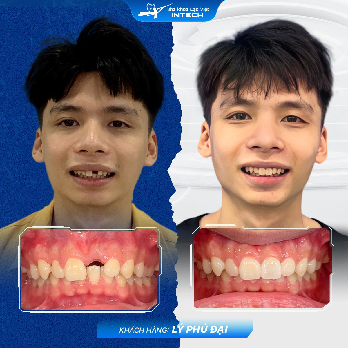 Phục hình răng cửa bằng Implant DCT, khôi phục thẩm mỹ hoàn hảo cho anh Nguyễn Văn Đại
