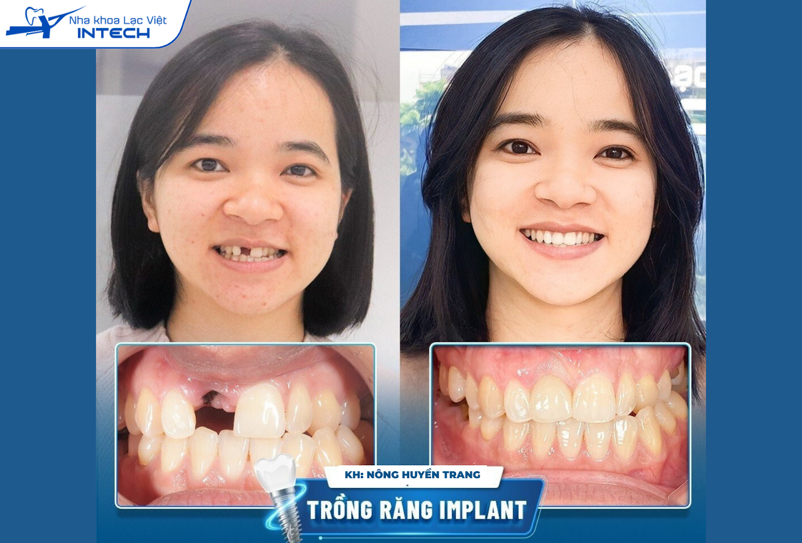 Sau 3 tháng trồng Implant bằng giải pháp DCT tại nha khoa Lạc Việt Intech, chị Nông Huyền Trang đã tự tin nở nụ cười và giao tiếp thoải mái