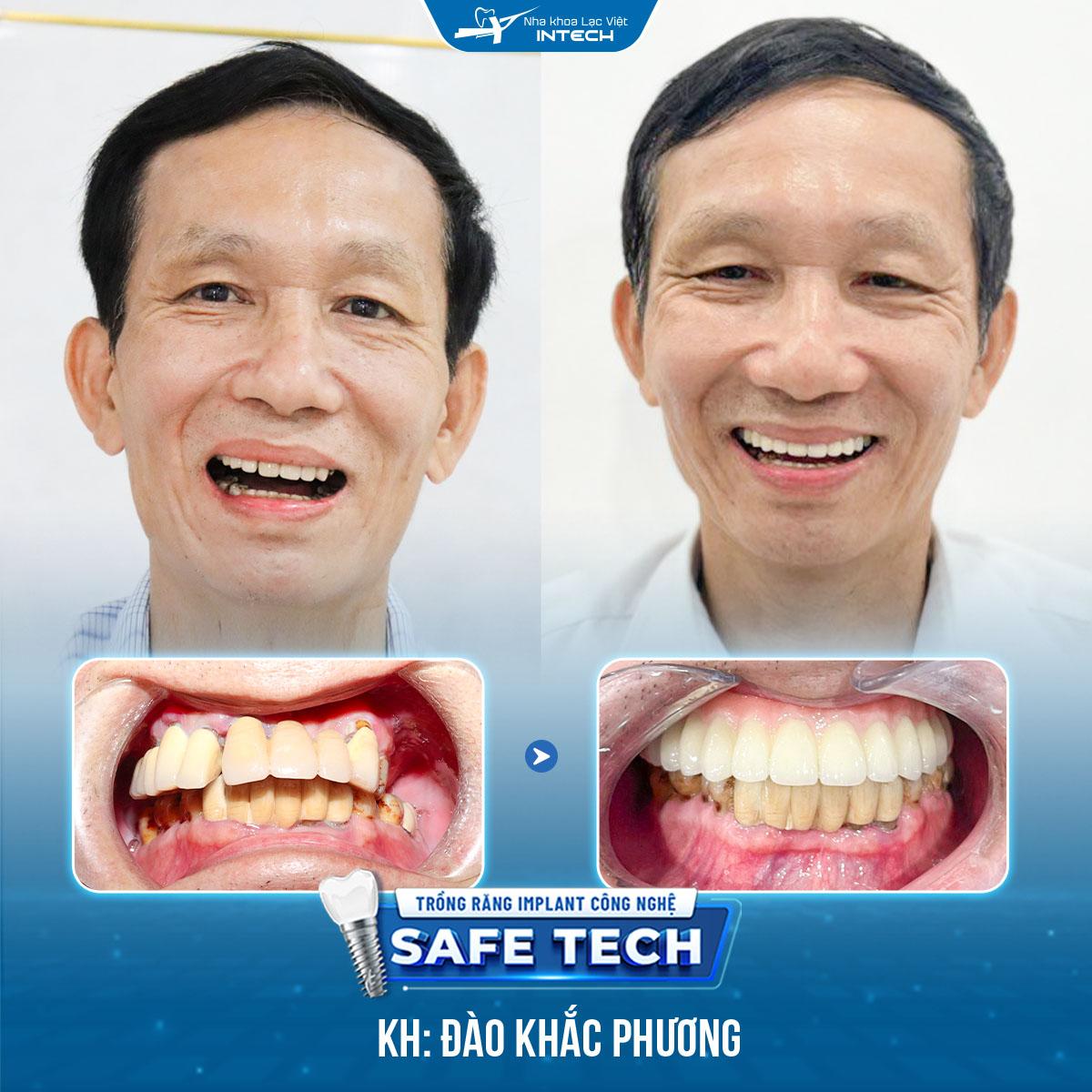 Hình ảnh trước và sau khi trồng răng Implant của chú Đào Khắc Phương