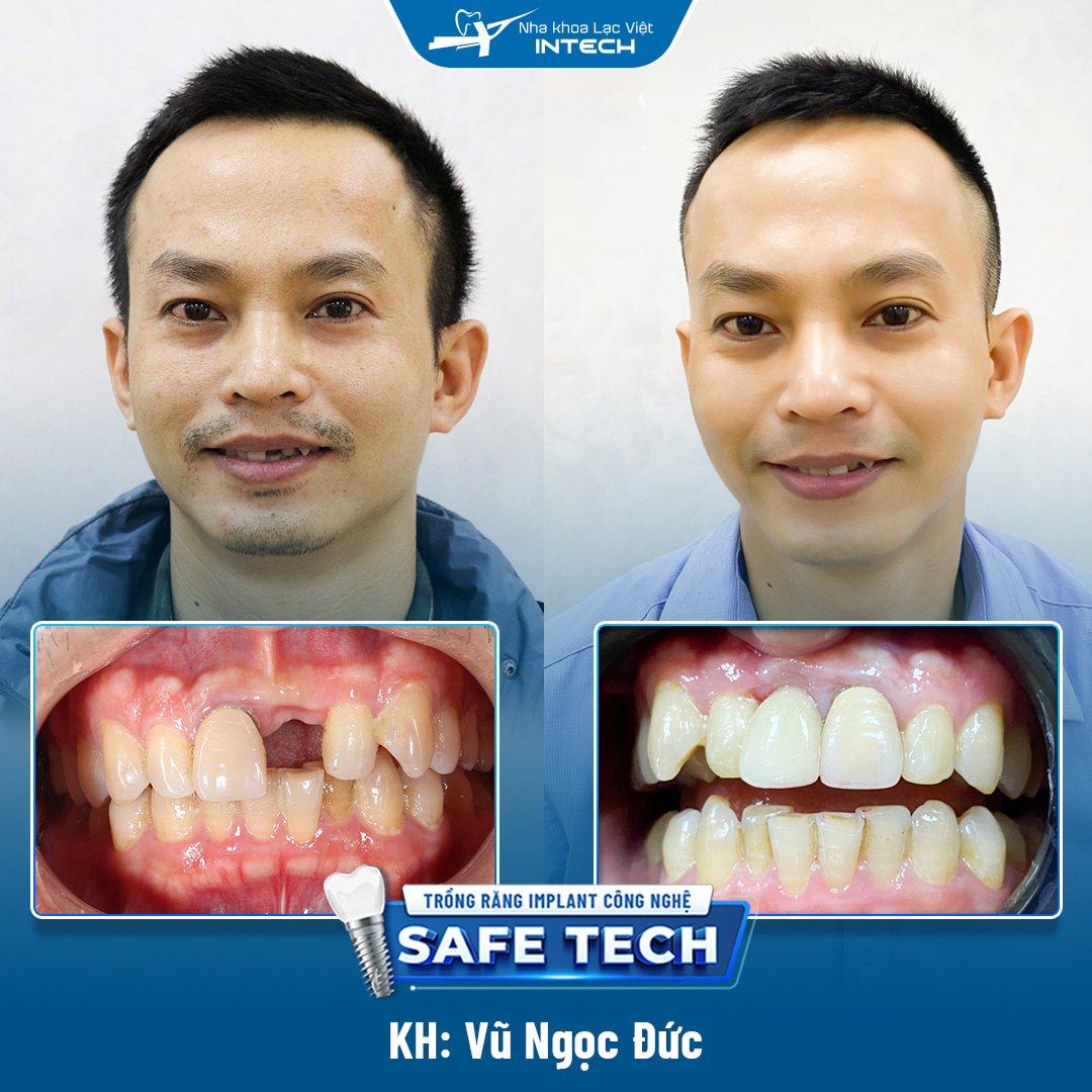 Hình ảnh khách hàng trước và sau phục hình Implant răng cửa tại Lạc Việt Intech
