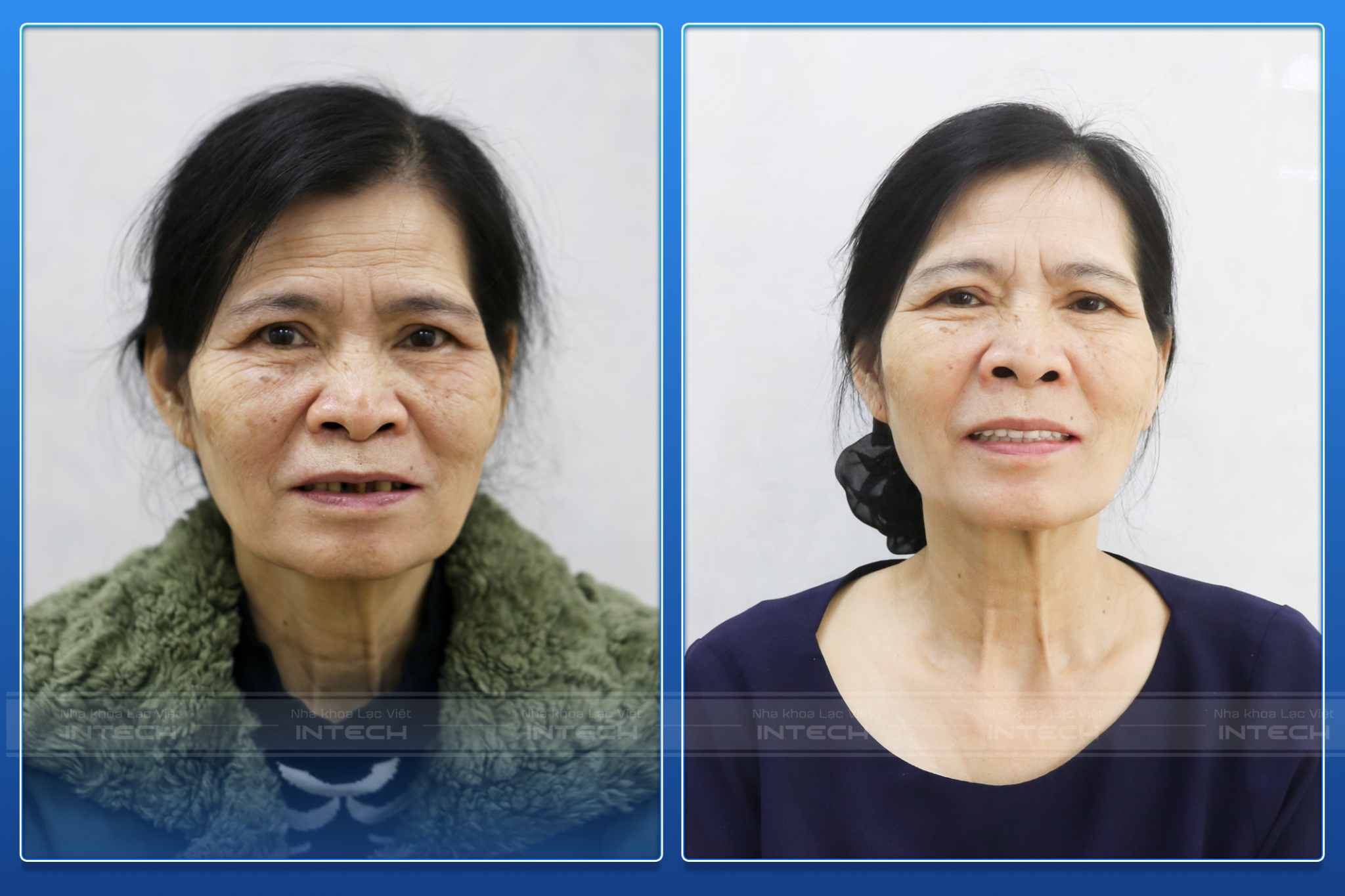 Hình ảnh trước và sau khi trồng răng của cô Hải tại Lạc Việt Intech 