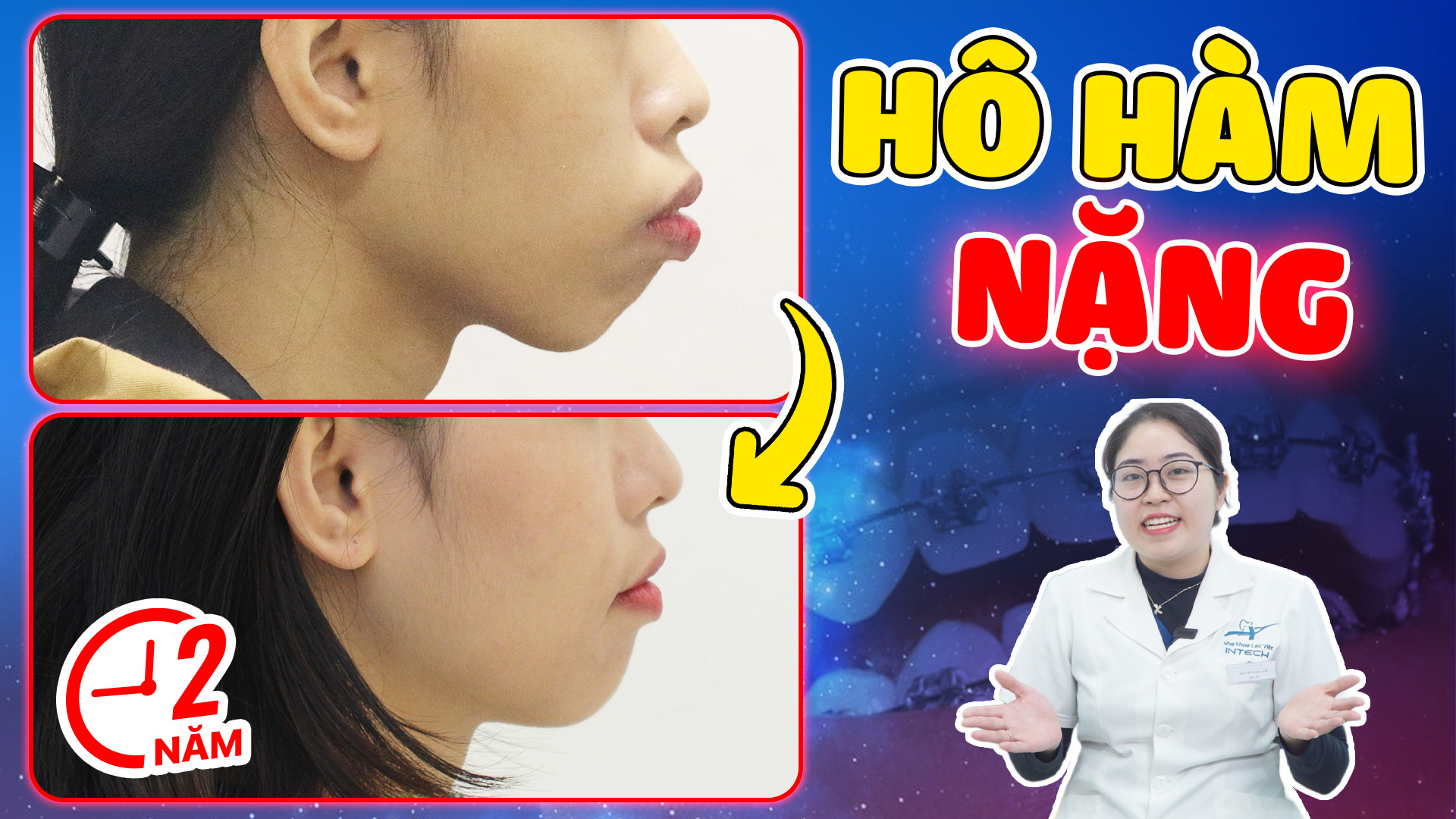 Hô hàm niềng răng có hết không? Xem ngay kết quả của 4 ca hô hàm điển hình 