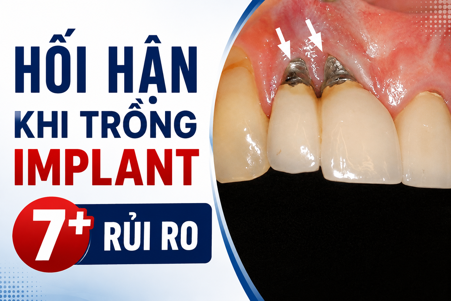 Hối Hận Khi Trồng Implant? 7+ Rủi Ro Cần Biết Để Tránh Implant Thất Bại