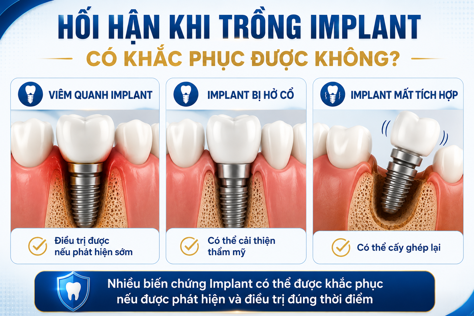 Hối hận khi trồng Implant có khắc phục được không? Các trường hợp viêm quanh Implant, Implant bị hở cổ và Implant mất tích hợp vẫn có thể được điều trị hoặc xử lý nếu phát hiện sớm.