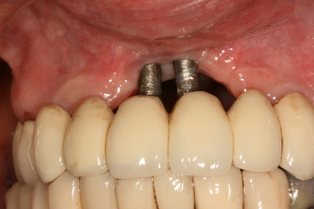 Hối hận trồng răng implant do sử dụng trụ giá rẻ.