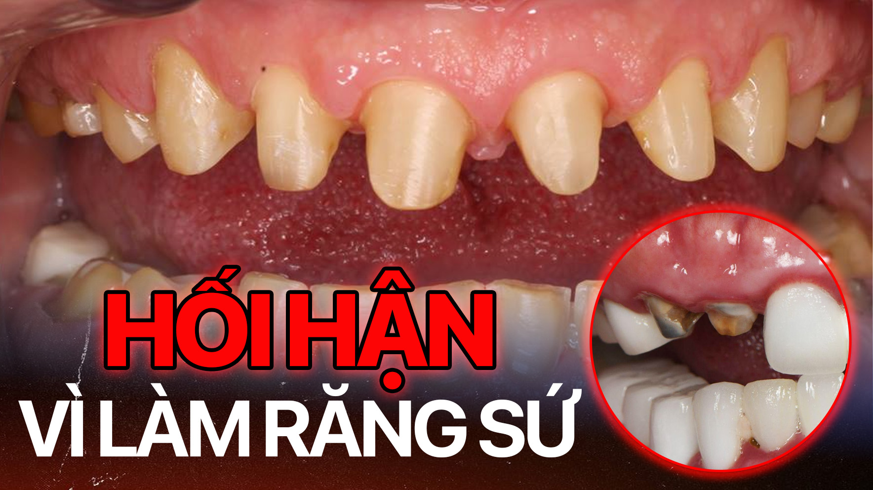 90% khách hàng hối hận vì làm răng sứ - Sự thật kinh hoàng phía sau nụ cười trăm triệu 