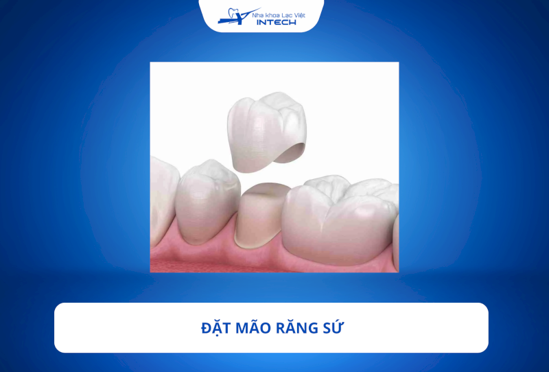 Lắp răng sứ là giai đoạn cuối cùng trong quá trình cấy ghép Implant 