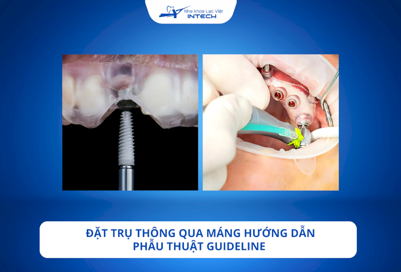 Máng hướng dẫn phẫu thuật Guideline đảm bảo đặt trụ chính xác, nhanh chóng 