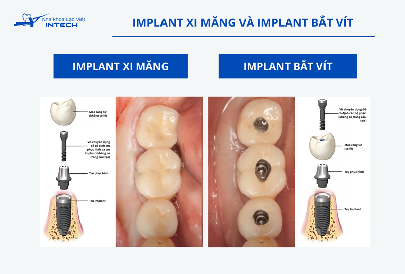 Tuy có cùng cấu tạo chính nhưng Implant bắt vít có thiết kế thông minh hơn, khắc phục tối đa các nhược điểm của Implant xi măng