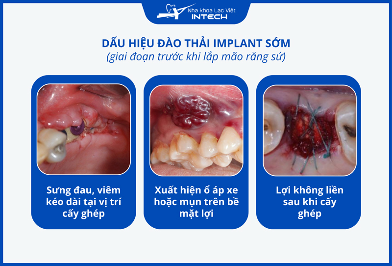 Implant bị đào thải sớm có thể bị sưng viêm kéo dài, xuất hiện các ổ áp xe, mụn mủ, hở vết thương gây đau đớn