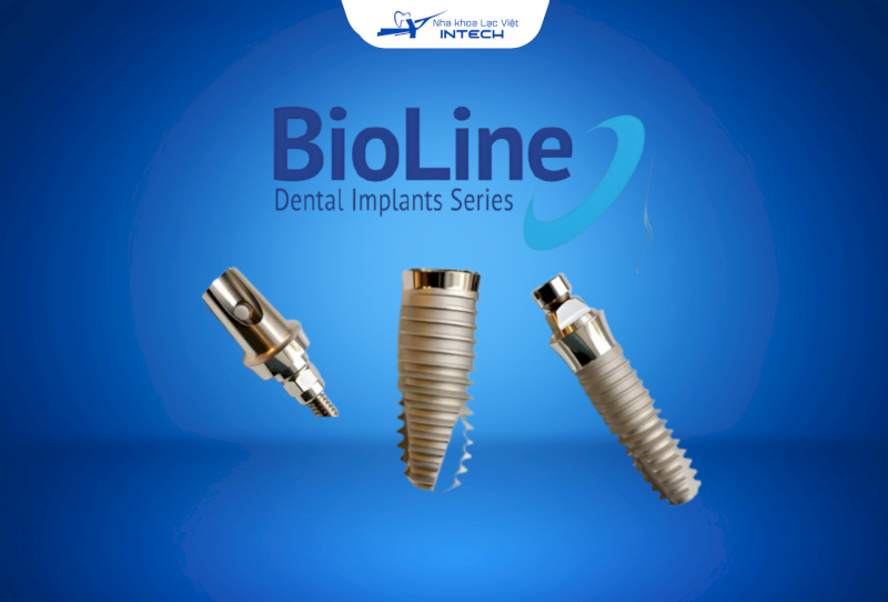 Thông tin mới nhất về trụ Implant BioLine: Nguồn gốc, cấu tạo, chi phí