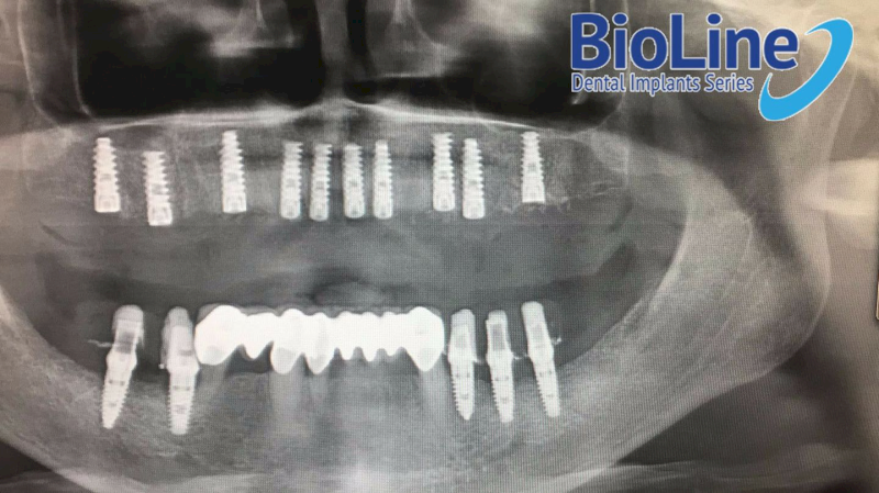 Trụ Implant BioLine tồn tại vững chắc trong xương hàm ở mọi vị trí mất răng