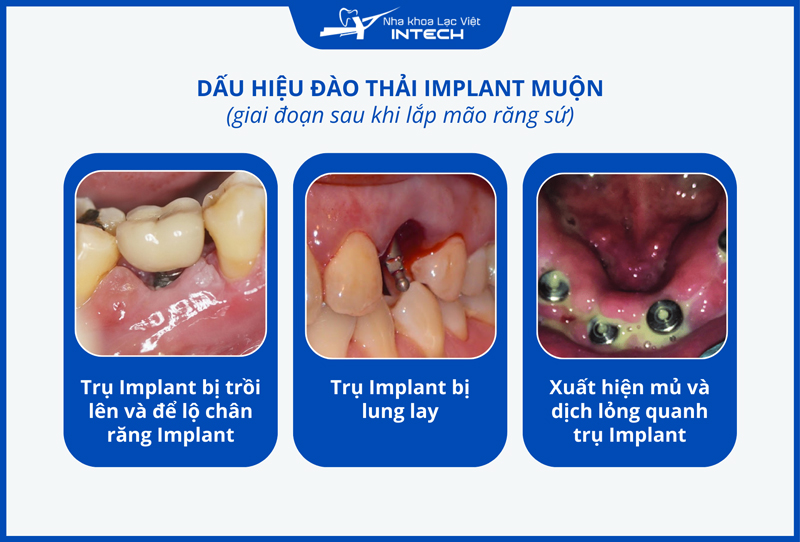 Implant đào thải muộn có thể trồi lên, chảy mủ hoặc dịch lỏng quanh vùng cấy ghép, bị lung lay, nghiêng lệch gây khó khăn khi ăn nhai