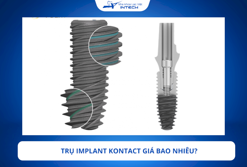 Trụ Implant Kontact giá bao nhiêu? Chất lượng như thế nào?