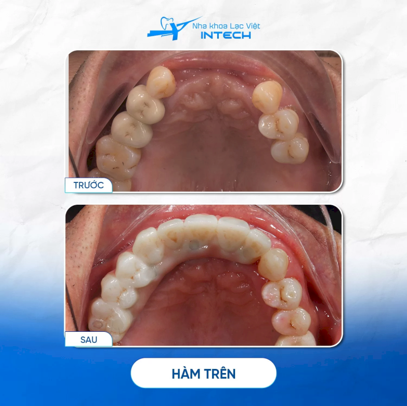 Trụ phù hợp với nhiều vị trí mất răng và các tình trạng xương hàm khác nhau