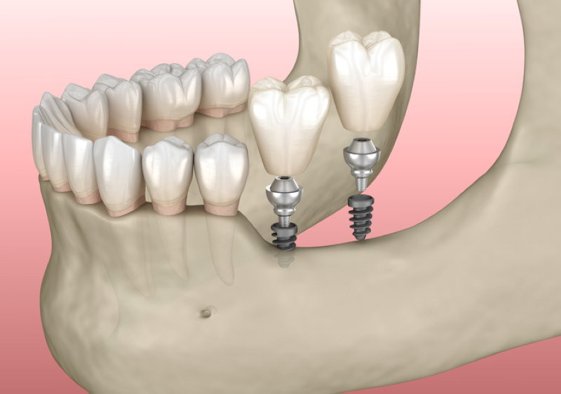 Implant mini là gì? Trường hợp được chỉ định sử dụng Implant mini