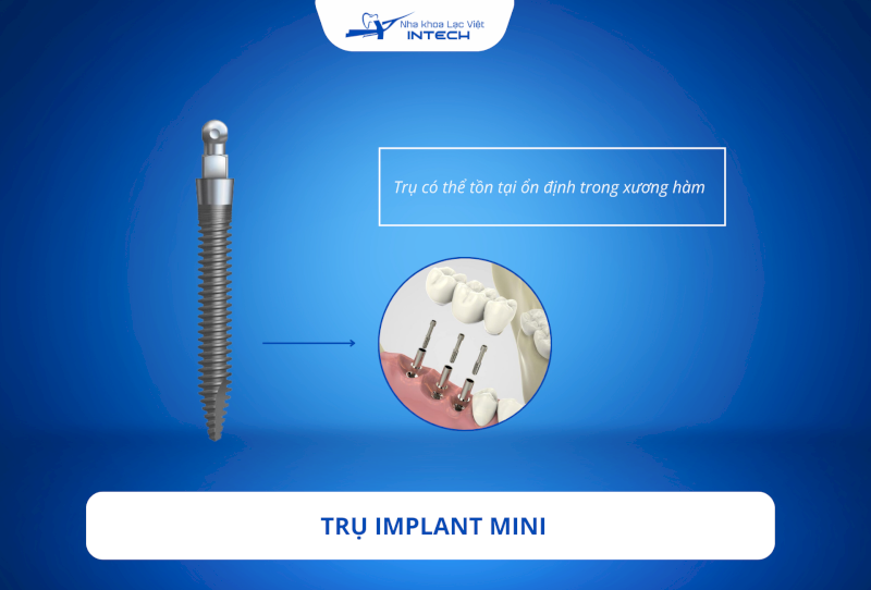 Trụ Implant mini vẫn tồn tại ổn định nếu được cấy ghép theo chỉ định