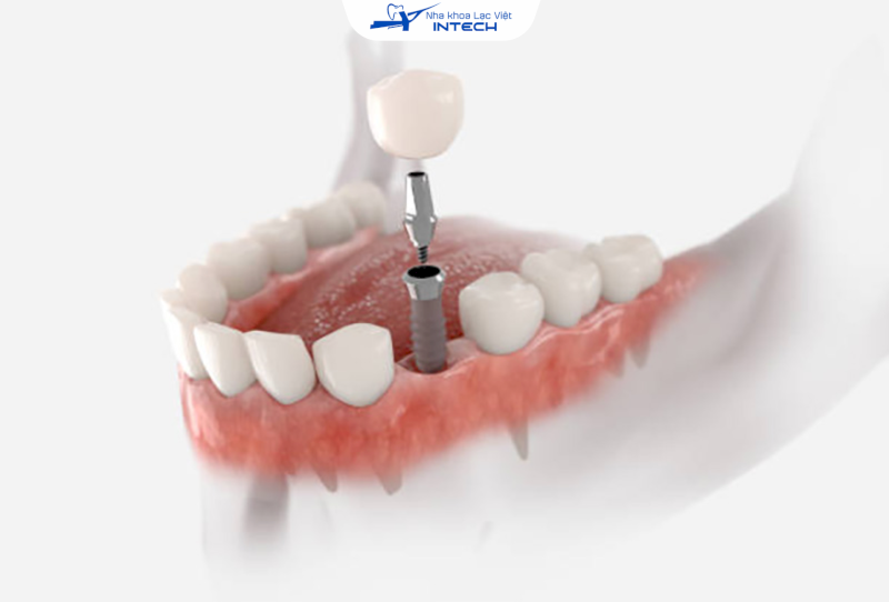 Chi phí trồng răng bằng trụ Implant Tekka Pháp tại Việt Nam hiện nay thường dao động tùy theo tình trạng răng miệng và dịch vụ đi kèm tại từng nha khoa