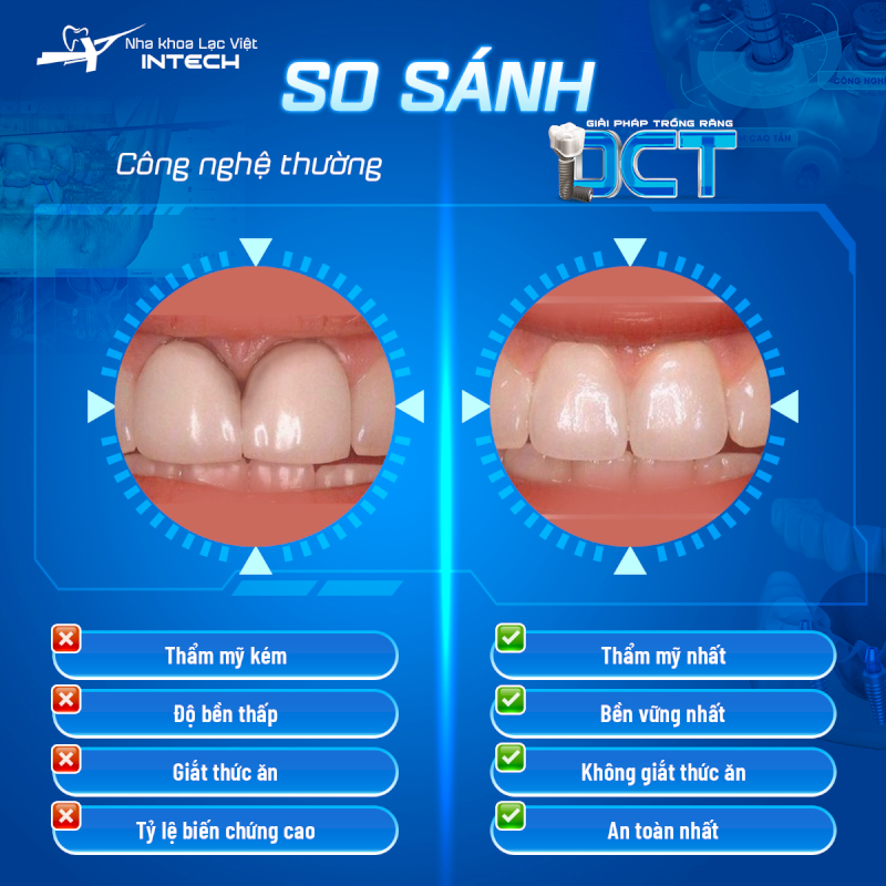 Cấy ghép Implant tức thì bằng giải pháp DCT tại nha khoa Lạc Việt Intech mang đến hiệu quả chân thật vượt trội