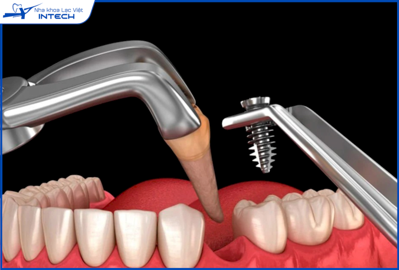 Cấy ghép Implant tức thì là gì? Trường hợp nào được chỉ định thực hiện