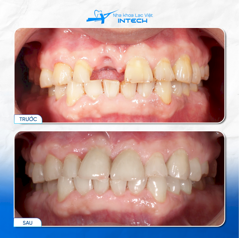 Cấy Implant tức thì vẫn đảm bảo chất lượng, độ bền và thẩm mỹ như phương pháp thông thường