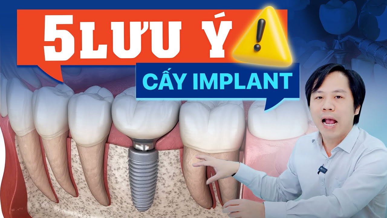 5 sai lầm phổ biến khi cấy trồng răng implant và cách khắc phục