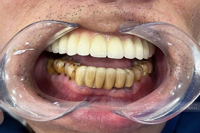 Kết quả sau khi lắp hàm cố định của chú Phương, bác sĩ thiết kế màu sắc, dáng răng tương đồng với răng thật