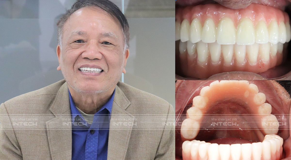 Kết quả sau khi lắp răng sứ của chú Nguyễn Văn Toán