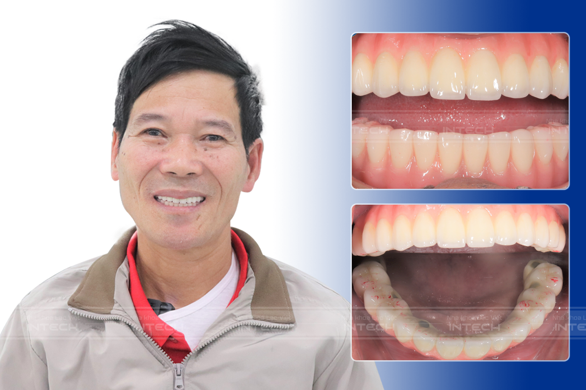 Hình ảnh chú Nguyễn Đức Tính sau khi lắp răng hoàn thiện