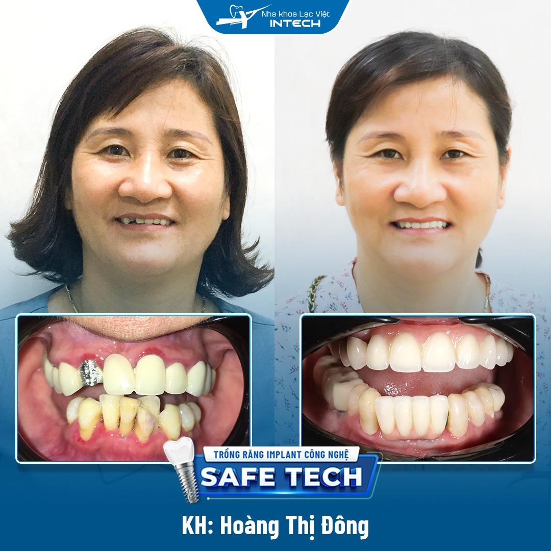 Kết quả sau khi trồng răng Implant của cô Hoàng Thị Đông tại Lạc Việt Intech