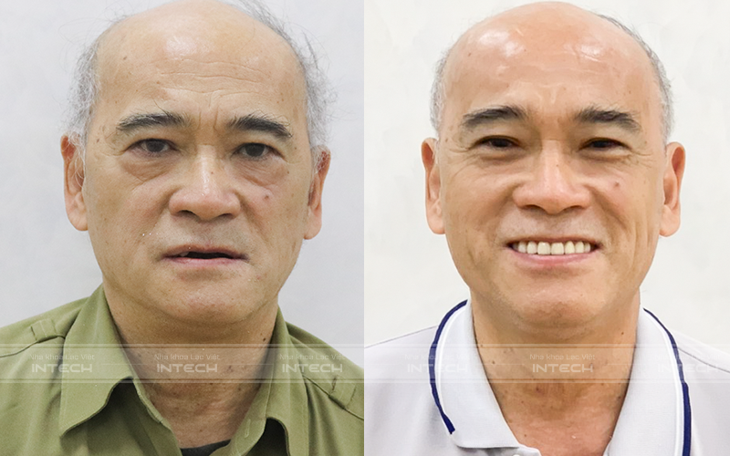 Kết quả trước và sau khi trồng răng Implant của khách hàng