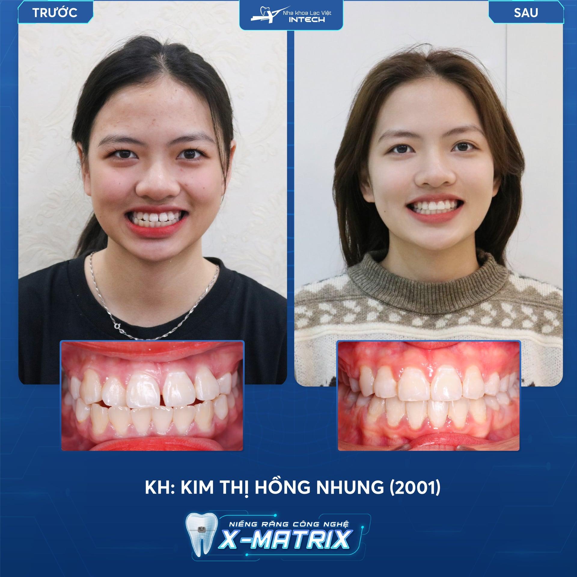 NIỀNG RĂNG MÓM