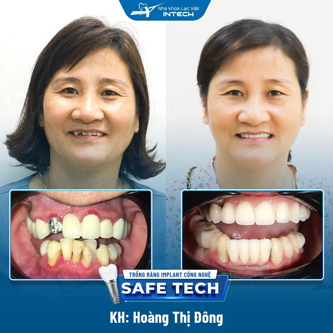 Cô Hoàng Thị Đông - Khách hàng trồng răng Implant toàn hàm bởi bác sĩ Duy