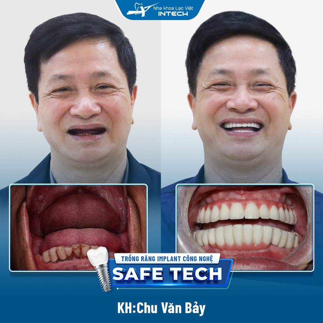 Khách hàng Chu Văn Bảy trước và sau trồng răng Implant toàn 2 hàm