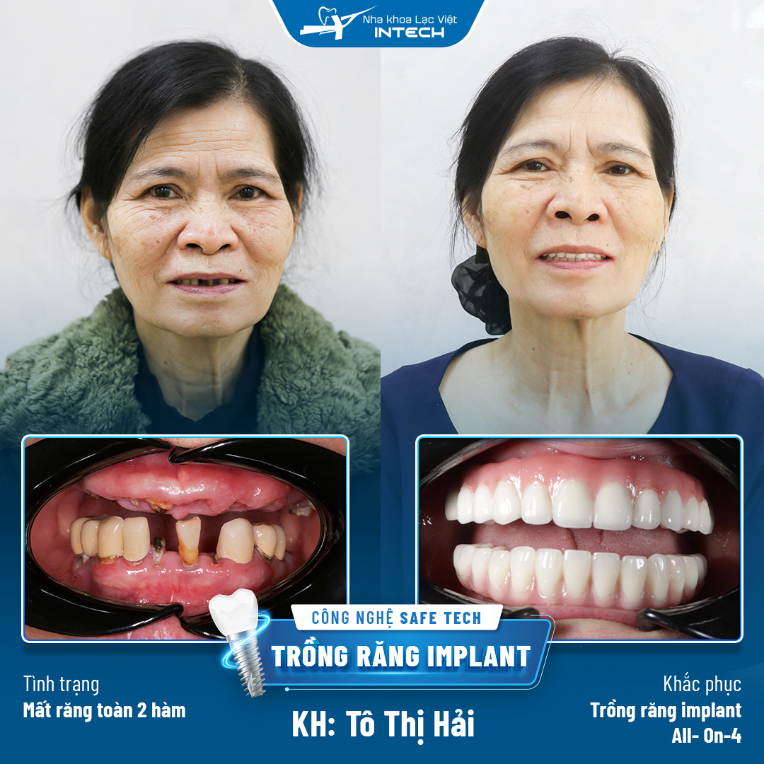 Cô Tô Thị Hải trồng răng Implant All On 4 toàn 2 hàm