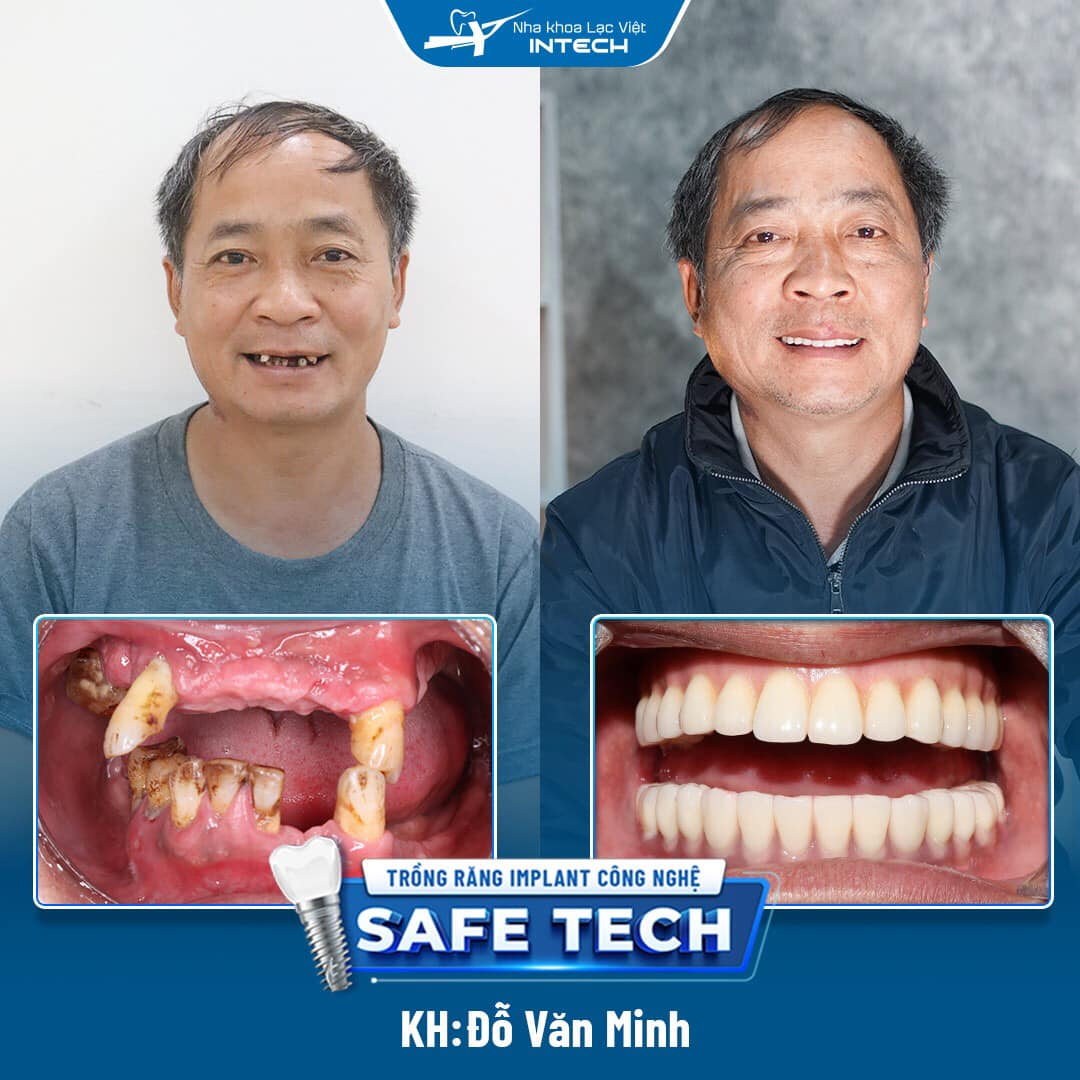 Khách hàng Đỗ Văn Minh trồng răng Implant All On 6 toàn 2 hàm