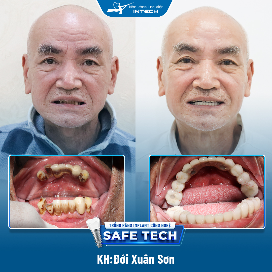 Khách hàng Đới Xuân Sơn trồng răng Implant All-On-4 toàn 2 hàm