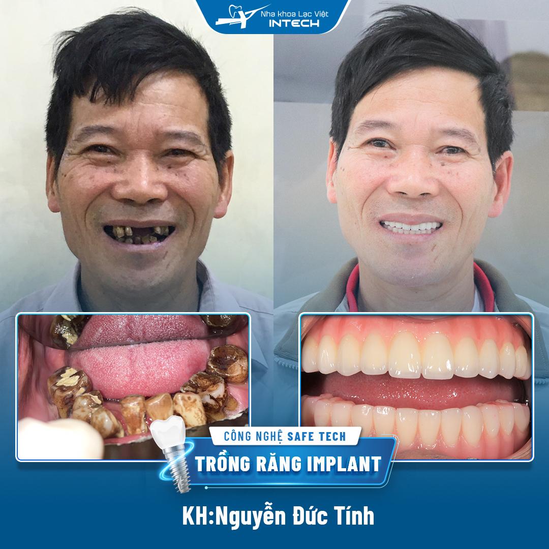 Hình ảnh chú Nguyễn Đức Tín trước và sau khi cấy ghép implant bằng công nghệ Safe - tech
